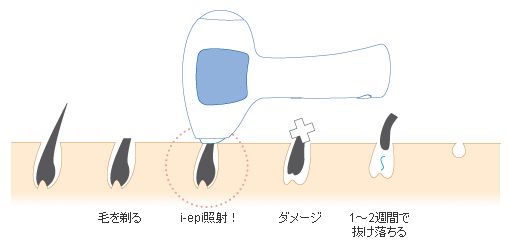 i-epi�i�A�C�G�s�j�̌��ʁA���\�A���R�~