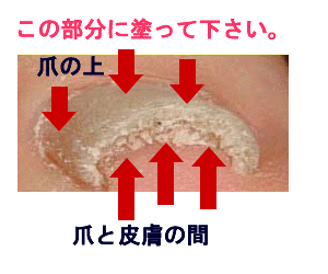 爪水虫の塗り薬　クリアネイルの効果、効能、口コミ